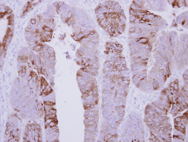 IHC of paraffin-embedded Colon ca, using COLQ antibody at 1:500 dilution.