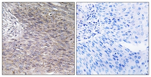 IHC of paraffin-embedded human cervix carcinoma tissue, using CHSY2 Antibody. The sample on the right was incubated with synthetic peptide.