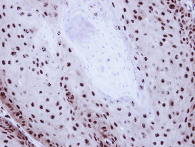 IHC of paraffin-embedded Cal27 Xenograft using GABP-beta1 antibody at 1:100 dilution.