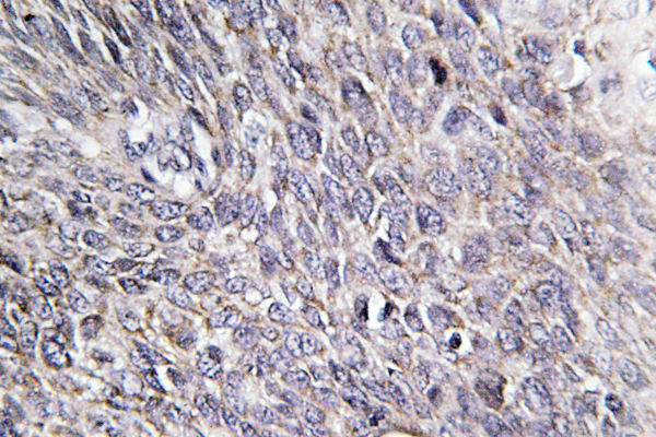 IHC of CHSY2 (R671) pAb in paraffin-embedded human cervix carcinoma tissue.