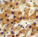 GAGE13 Antibody immunohistochemistry of formalin-fixed and paraffin-embedded human hepatocarcinoma followed by peroxidase-conjugated secondary antibody and DAB staining.