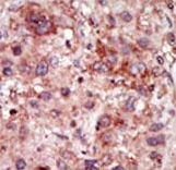 Formalin-fixed and paraffin-embedded human cancer tissue reacted with the primary antibody, which was peroxidase-conjugated to the secondary antibody, followed by DAB staining. This data demonstrates the use of this antibody for immunohistochemistry; clinical relevance has not been evaluated. BC = breast carcinoma; HC = hepatocarcinoma.