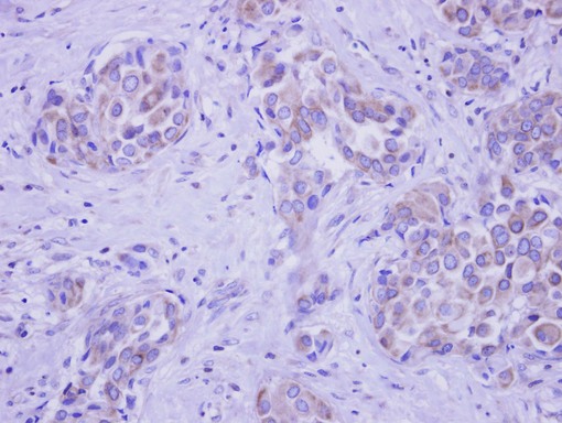 IHC of paraffin-embedded Breast ca, using GALNT2 antibody at 1:250 dilution.
