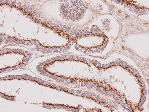 IHC of paraffin-embedded Endometrial CA using GALNT7 antibody at 1:100 dilution.