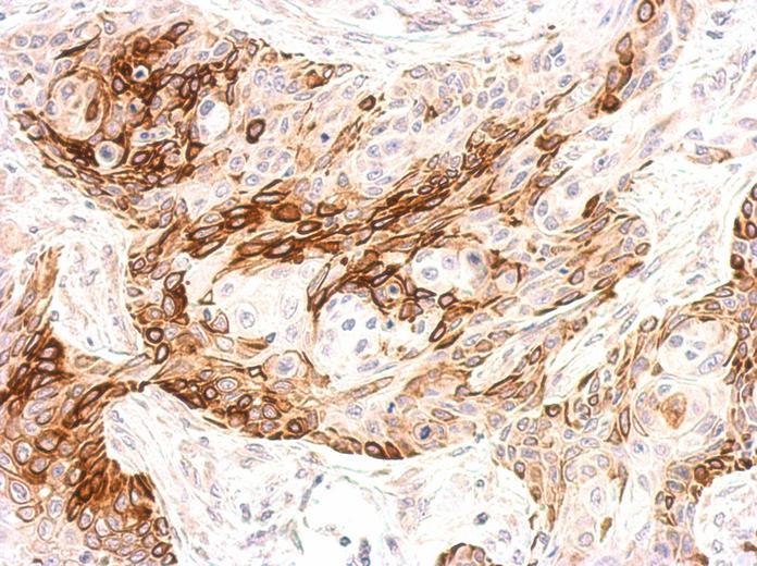 Galanin Receptor 2 antibody detects GALR2 protein at membrane on Cal27 xenograft by immunohistochemical analysis. Sample: Paraffin-embedded Cal27 xenograft. Galanin Receptor 2 antibody dilution:1:500.