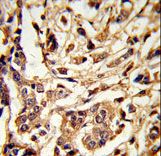 Formalin-fixed and paraffin-embedded human breast carcinoma reacted with GALT Antibody , which was peroxidase-conjugated to the secondary antibody, followed by DAB staining. This data demonstrates the use of this antibody for immunohistochemistry; clinical relevance has not been evaluated.