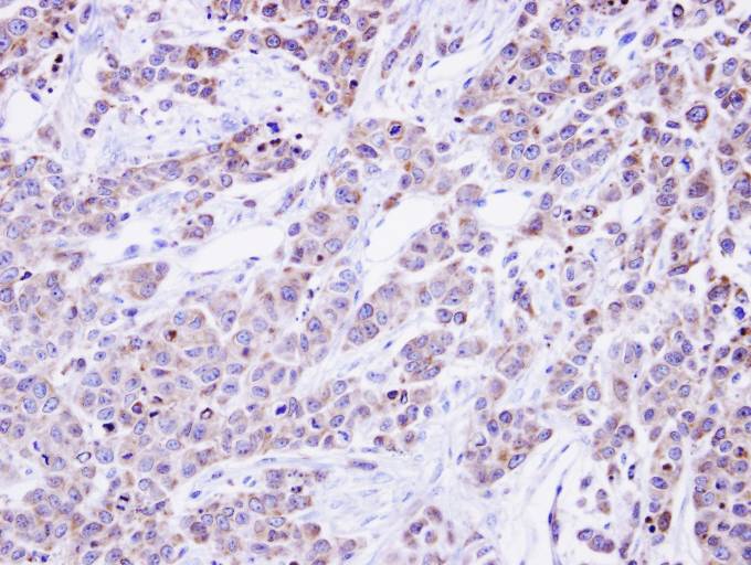 IHC of paraffin-embedded SG xenograft using alpha Glucosidase II antibody at 1:500 dilution.