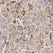 Immunohistochemistry of paraffin-embedded human liver cancer tissue using GAS2 antibody at dilution of 1:200 (x400 lens).