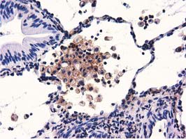 IHC of paraffin-embedded Carcinoma of Human lung tissue using anti-GAS7 mouse monoclonal antibody.
