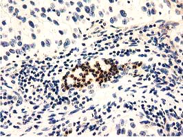 IHC of paraffin-embedded Carcinoma of Human bladder tissue using anti-GAS7 mouse monoclonal antibody.