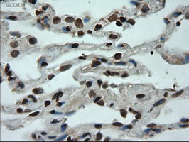 IHC of paraffin-embedded Carcinoma of lung using anti-GATA6 mouse monoclonal antibody.