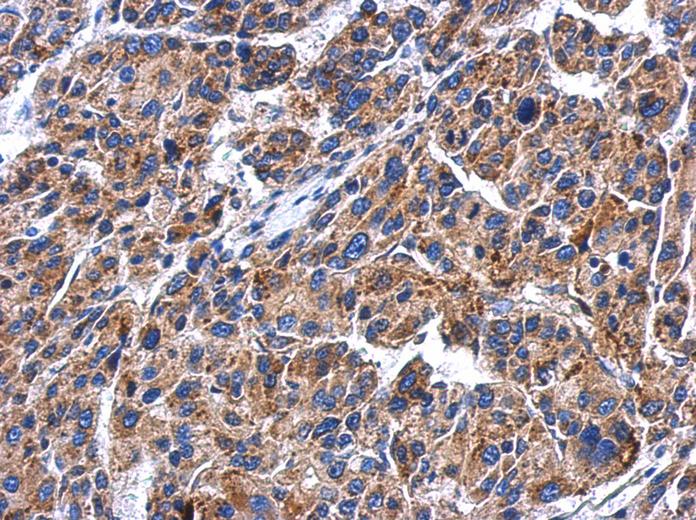 IHC of paraffin-embedded Hepatoma using GBA antibody at 1:500 dilution.