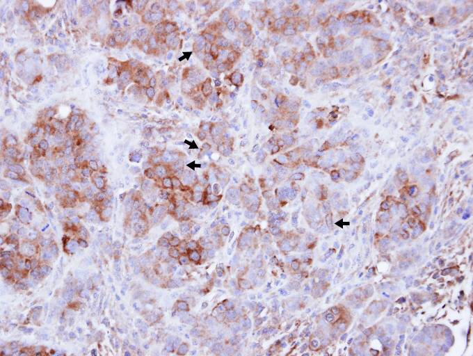 IHC of paraffin-embedded NCIN87 xenograft using Guanylate-binding protein 3 antibody at 1:100 dilution.