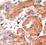 Formalin-fixed and paraffin-embedded human cancer tissue reacted with the primary antibody, which was peroxidase-conjugated to the secondary antibody, followed by DAB staining. This data demonstrates the use of this antibody for immunohistochemistry; clinical relevance has not been evaluated. BC = breast carcinoma; HC = hepatocarcinoma.