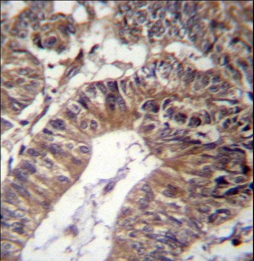 GCC1 Antibody immunohistochemistry of formalin-fixed and paraffin-embedded human colon carcinoma followed by peroxidase-conjugated secondary antibody and DAB staining.