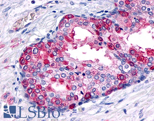 Anti-GCGR / Glucagon Receptor antibody IHC of human Prostate, Carcinoma. Immunohistochemistry of formalin-fixed, paraffin-embedded tissue after heat-induced antigen retrieval.