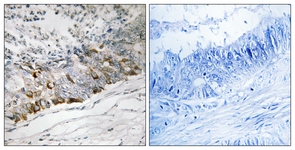 IHC of paraffin-embedded human colon carcinoma tissue, using GCHFR Antibody. The picture on the right is treated with the synthesized peptide.