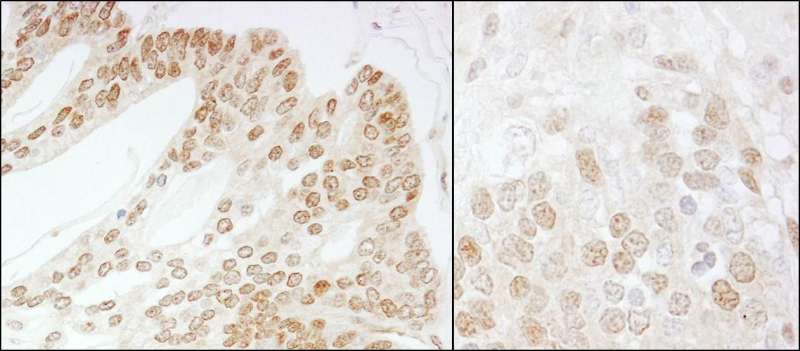 Detection of Human and Mouse CSN5 by Immunohistochemistry. Sample: FFPE section of human prostate carcinoma (left) and mouse teratoma (right). Antibody: Affinity purified rabbit anti-CSN5 used at a dilution of 1:500 (2 ug/ml). Detection: DAB.