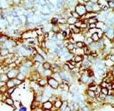 Formalin-fixed and paraffin-embedded human cancer tissue reacted with the primary antibody, which was peroxidase-conjugated to the secondary antibody, followed by AEC staining. This data demonstrates the use of this antibody for immunohistochemistry; clinical relevance has not been evaluated. BC = breast carcinoma; HC = hepatocarcinoma.