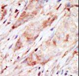 Formalin-fixed and paraffin-embedded human cancer tissue reacted with the primary antibody, which was peroxidase-conjugated to the secondary antibody, followed by AEC staining. This data demonstrates the use of this antibody for immunohistochemistry; clinical relevance has not been evaluated. BC = breast carcinoma; HC = hepatocarcinoma.