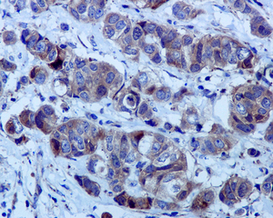 IHC of paraffin-embedded human breast carcinoma tissue using anti-GCLM antibody.