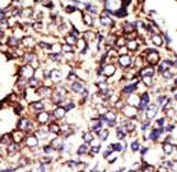 Formalin-fixed and paraffin-embedded human cancer tissue reacted with the primary antibody, which was peroxidase-conjugated to the secondary antibody, followed by DAB staining. This data demonstrates the use of this antibody for immunohistochemistry; clinical relevance has not been evaluated. BC = breast carcinoma; HC = hepatocarcinoma.