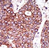 Formalin-fixed and paraffin-embedded human cancer tissue reacted with the primary antibody, which was peroxidase-conjugated to the secondary antibody, followed by DAB staining. This data demonstrates the use of this antibody for immunohistochemistry; clinical relevance has not been evaluated. BC = breast carcinoma; HC = hepatocarcinoma.