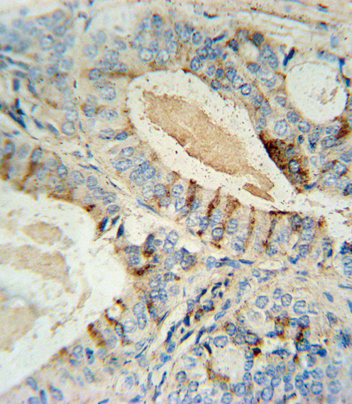 GCNT2 antibody immunohistochemistry of formalin-fixed and paraffin-embedded human prostate carcinoma followed by peroxidase-conjugated secondary antibody and DAB staining.