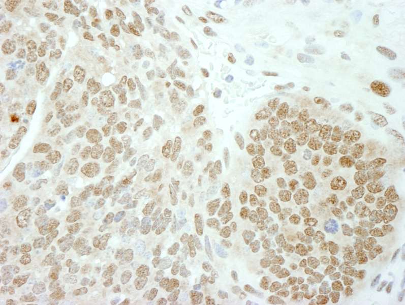 Detection of Mouse PolE3/p17 by Immunohistochemistry. Sample: FFPE section of mouse teratoma. Antibody: Affinity purified rabbit anti-PolE3/p17 used at a dilution of 1:100.