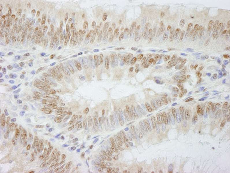 Detection of Human PolE3/p17 by Immunohistochemistry. Sample: FFPE section of human colon carcinoma. Antibody: Affinity purified rabbit anti-PolE3/p17 used at a dilution of 1:500.