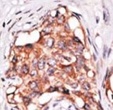 Formalin-fixed and paraffin-embedded human cancer tissue reacted with the primary antibody, which was peroxidase-conjugated to the secondary antibody, followed by DAB staining. This data demonstrates the use of this antibody for immunohistochemistry; clinical relevance has not been evaluated. BC = breast carcinoma; HC = hepatocarcinoma.