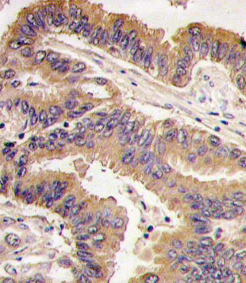Formalin-fixed and paraffin-embedded human lung carcinoma tissue reacted with GDF5 antibody , which was peroxidase-conjugated to the secondary antibody, followed by DAB staining. This data demonstrates the use of this antibody for immunohistochemistry; clinical relevance has not been evaluated.