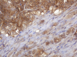 IHC of paraffin-embedded Adenocarcinoma of Human colon tissue using anti-COPS6 mouse monoclonal antibody.
