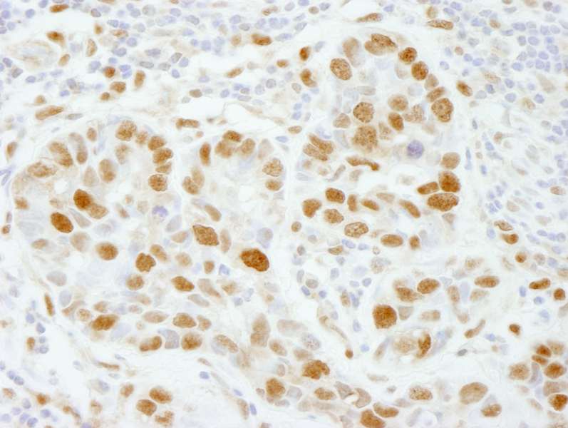 Detection of Human PolD3/p66 by Immunohistochemistry. Sample: FFPE section of human breast carcinoma. Antibody: Affinity purified rabbit anti-PolE3/p17 used at a dilution of 1:100.