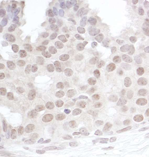 Detection of Human Gemin4 by Immunohistochemistry. Sample: FFPE section of human breast carcinoma. Antibody: Affinity purified rabbit anti-Gemin4 used at a dilution of 1:200 (1 Detection: DAB.
