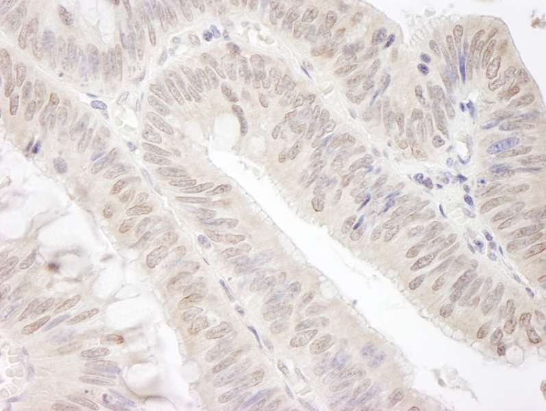 Detection of Human Gemin4 by Immunohistochemistry. Sample: FFPE section of human colon carcinoma. Antibody: Affinity purified rabbit anti-Gemin4 used at a dilution of 1:250. Epitope Retrieval Buffer-High pH (IHC-101J) was substituted for Epitope Retrieval Buffer-Reduced pH.