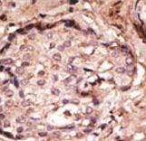 Formalin-fixed and paraffin-embedded human cancer tissue reacted with the primary antibody, which was peroxidase-conjugated to the secondary antibody, followed by DAB staining. This data demonstrates the use of this antibody for immunohistochemistry; clinical relevance has not been evaluated. BC = breast carcinoma; HC = hepatocarcinoma.