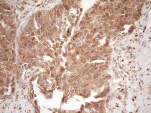 IHC of paraffin-embedded Carcinoma of Human kidney tissue using anti-GFI1 mouse monoclonal antibody. (Heat-induced epitope retrieval by 1 mM EDTA in 10mM Tris, pH8.5, 120°C for 3min).