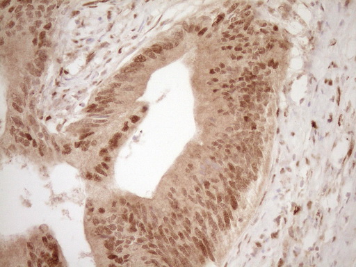 IHC of paraffin-embedded Adenocarcinoma of Human colon tissue using anti-GFI1 mouse monoclonal antibody. (Heat-induced epitope retrieval by 1 mM EDTA in 10mM Tris, pH8.5, 120°C for 3min).