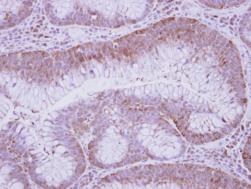 IHC of paraffin-embedded Colon ca, using GFOD2 antibody at 1:250 dilution.