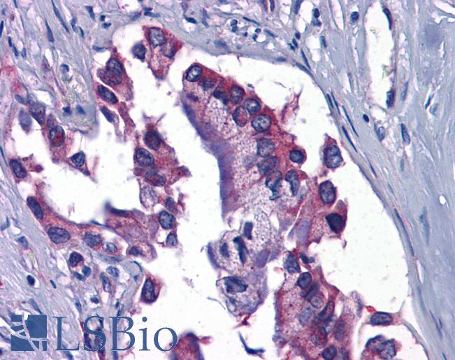 Anti-GFPT1 / GFAT antibody IHC of human Pancreas, Carcinoma. Immunohistochemistry of formalin-fixed, paraffin-embedded tissue after heat-induced antigen retrieval.
