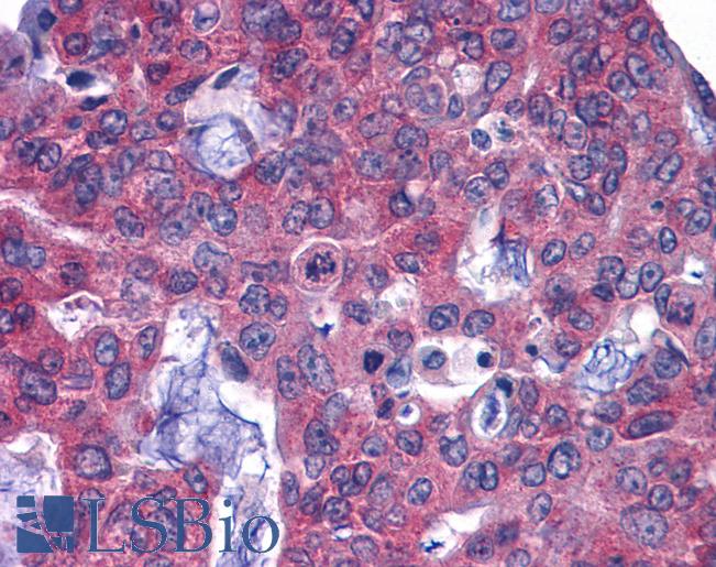 Anti-GFPT1 / GFAT antibody IHC of human Colon, Carcinoma. Immunohistochemistry of formalin-fixed, paraffin-embedded tissue after heat-induced antigen retrieval.