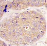 Formalin-fixed and paraffin-embedded human breast carcinoma tissue reacted with GGPS1 Antibody , which was peroxidase-conjugated to the secondary antibody, followed by DAB staining. This data demonstrates the use of this antibody for immunohistochemistry; clinical relevance has not been evaluated.