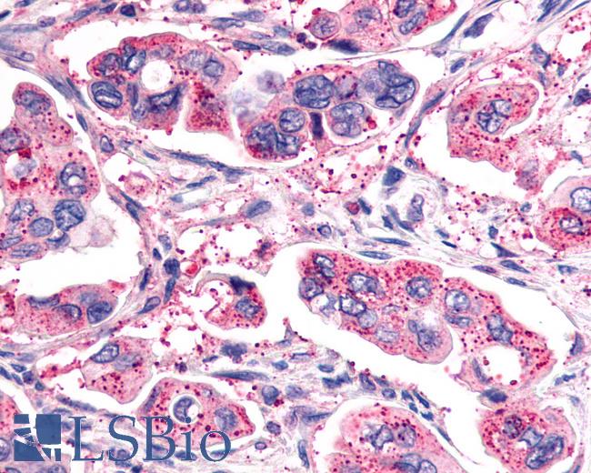 Anti-GHRHR antibody IHC of human Pancreas, Carcinoma. Immunohistochemistry of formalin-fixed, paraffin-embedded tissue after heat-induced antigen retrieval.