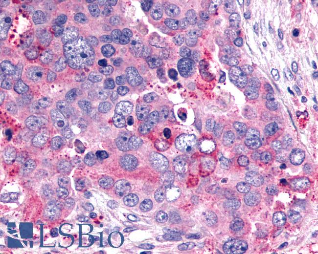 Anti-GHRHR antibody IHC of human Ovary, Carcinoma. Immunohistochemistry of formalin-fixed, paraffin-embedded tissue after heat-induced antigen retrieval.