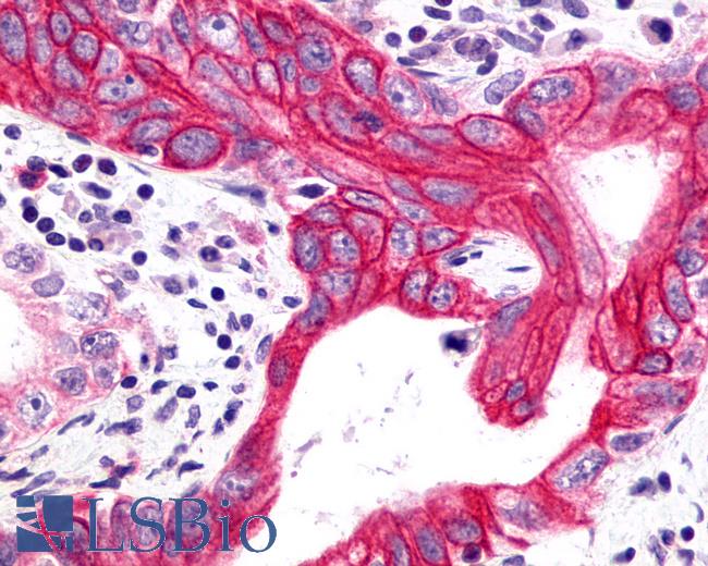 Anti-GHRHR antibody IHC of human Pancreas, Carcinoma. Immunohistochemistry of formalin-fixed, paraffin-embedded tissue after heat-induced antigen retrieval.