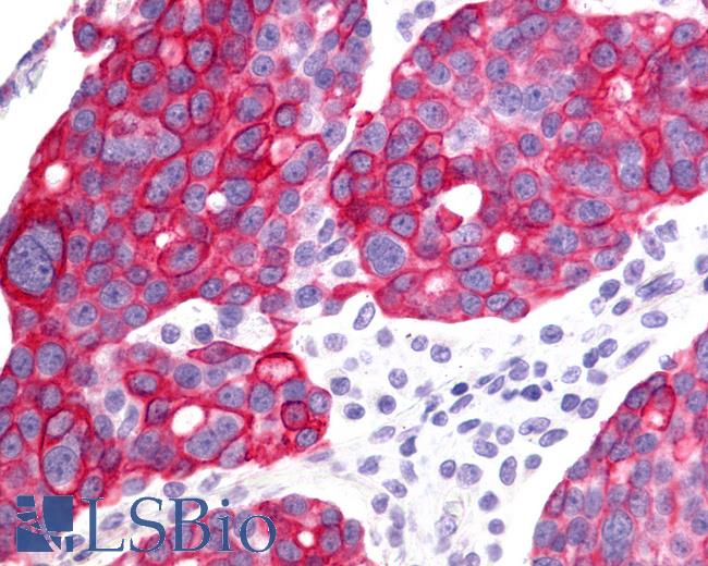 Anti-GHRHR antibody IHC of human Ovary, Carcinoma. Immunohistochemistry of formalin-fixed, paraffin-embedded tissue after heat-induced antigen retrieval.