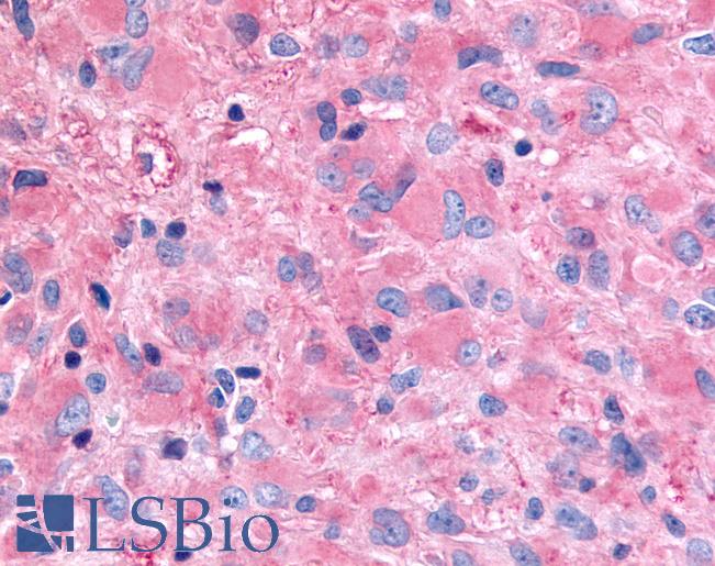 Anti-GHSR / Ghrelin Receptor antibody IHC of human Brain, Glioblastoma. Immunohistochemistry of formalin-fixed, paraffin-embedded tissue after heat-induced antigen retrieval.