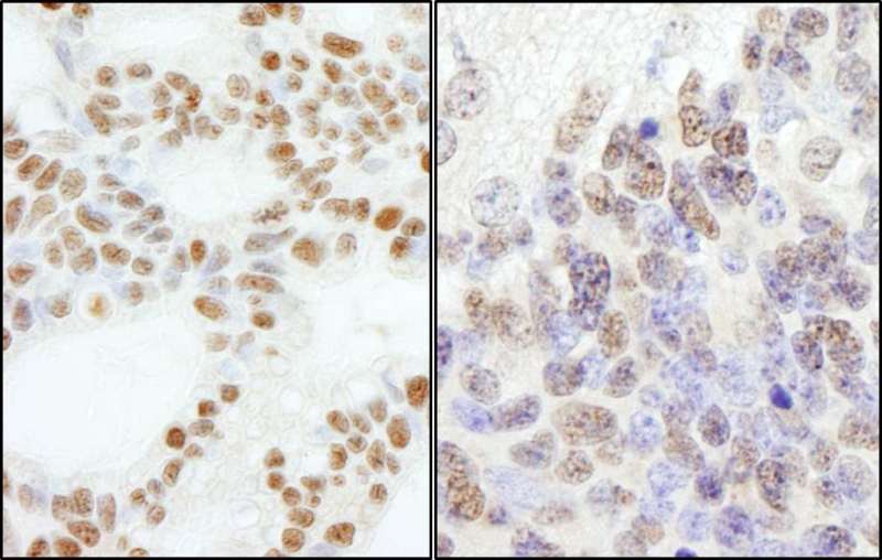 Detection of Human and Mouse PolE3/p17 by Immunohistochemistry. Sample: FFPE section of human ovarian carcinoma (left) and mouse teratoma (right). Antibody: Affinity purified rabbit anti-PolE3/p17 used at a dilution of 1:5000 (0.2 ug/ml). Detection: DAB.