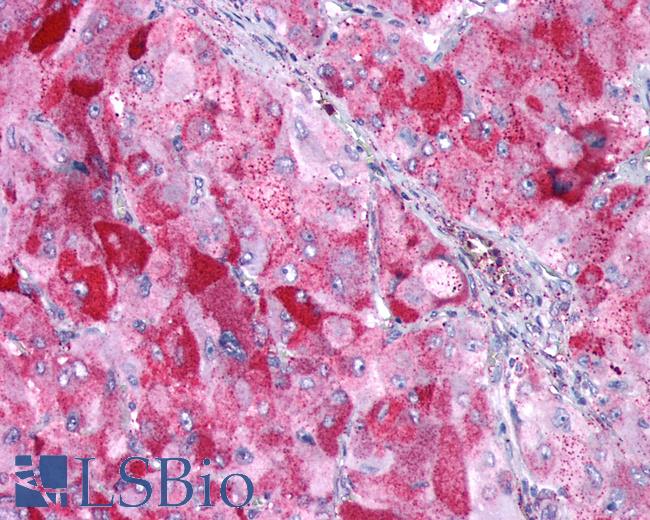 Anti-GIPR / GIP Receptor antibody IHC of human Adrenal, Pheochromocytoma. Immunohistochemistry of formalin-fixed, paraffin-embedded tissue after heat-induced antigen retrieval.